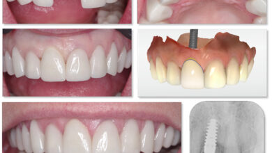 Photo of Mất răng nên trồng răng sứ hay cấy ghép Implant