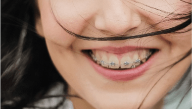Photo of Bạn có nên niềng răng ? Những điều quan trọng cần xem xét